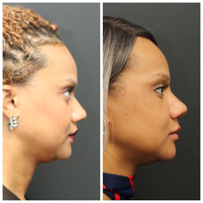 Rhinoplasty Before & After Gallery - Patient 11681683 - Image 1