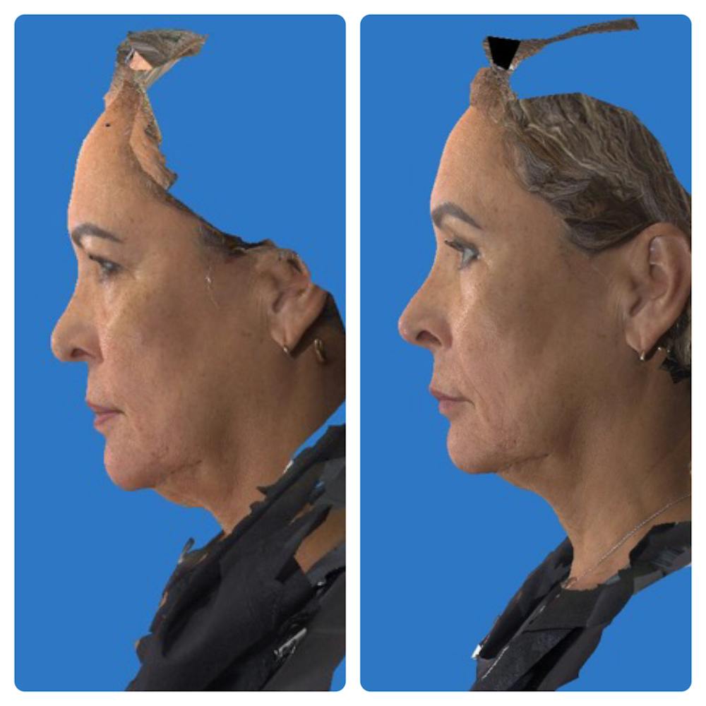 Rhinoplasty Before & After Gallery - Patient 11681684 - Image 1