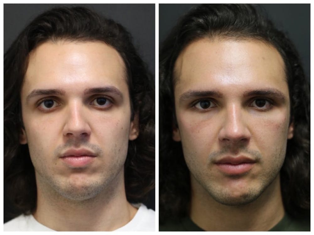 Rhinoplasty Before & After Gallery - Patient 11681685 - Image 1