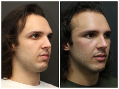 Rhinoplasty Before & After Gallery - Patient 11681685 - Image 2