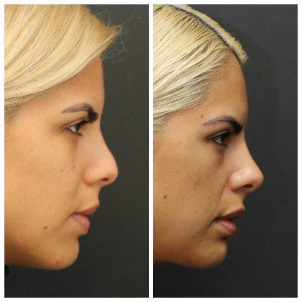 Rhinoplasty Before & After Gallery - Patient 11681686 - Image 2