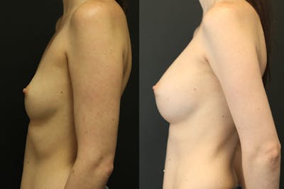 Breast Augmentation Before & After Gallery - Patient 11681775 - Image 4
