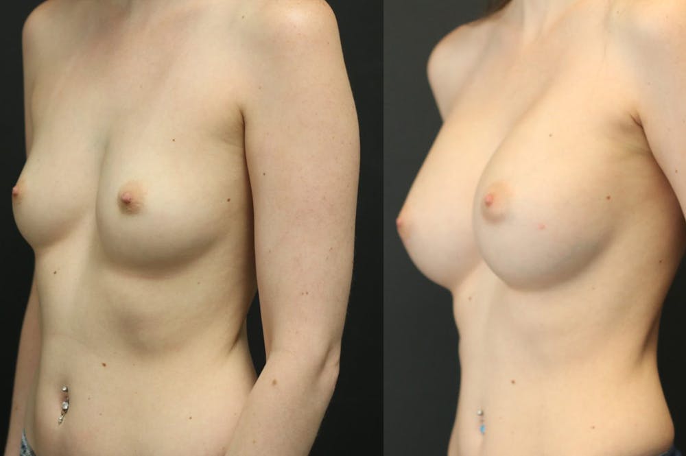 Breast Augmentation Before & After Gallery - Patient 11681775 - Image 3