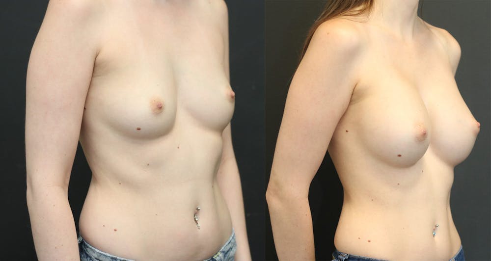 Breast Augmentation Before & After Gallery - Patient 11681775 - Image 1