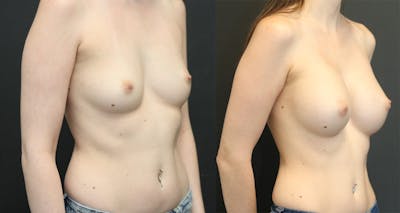 Breast Augmentation Before & After Gallery - Patient 11681775 - Image 1