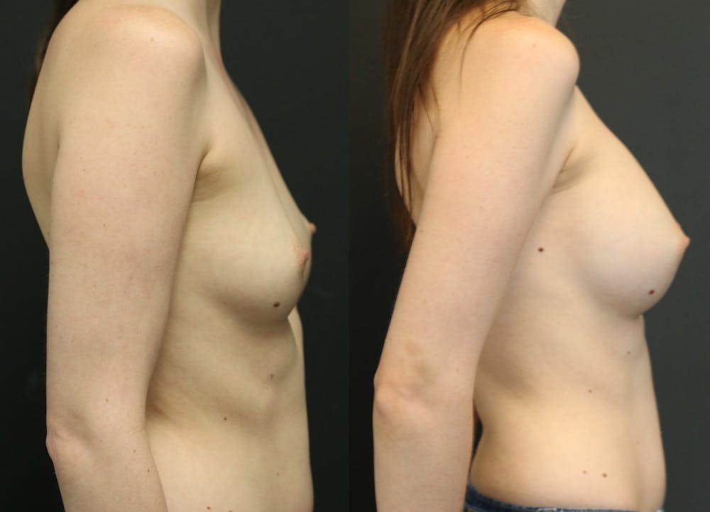 Breast Augmentation Before & After Gallery - Patient 11681775 - Image 2