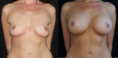 Breast Augmentation Before & After Gallery - Patient 11681776 - Image 1