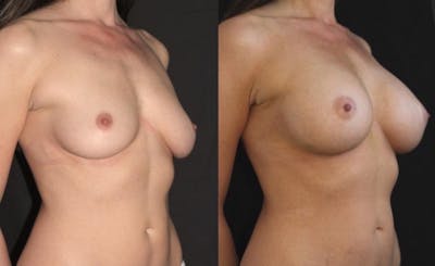 Breast Augmentation Before & After Gallery - Patient 11681776 - Image 4
