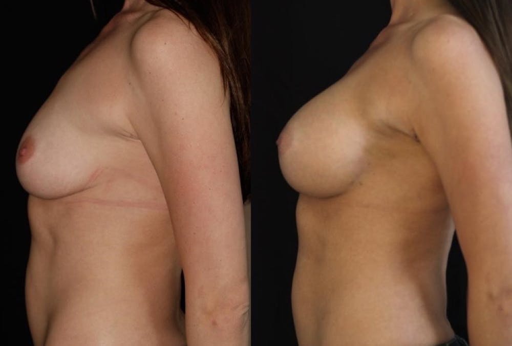 Breast Augmentation Before & After Gallery - Patient 11681776 - Image 3