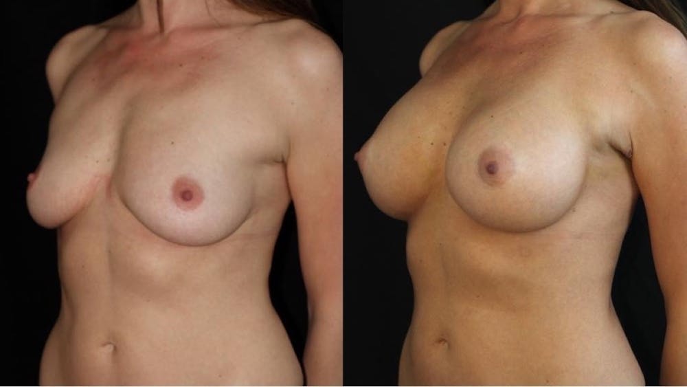 Breast Augmentation Before & After Gallery - Patient 11681776 - Image 2