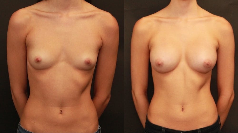 Breast Augmentation Before & After Gallery - Patient 11681777 - Image 1