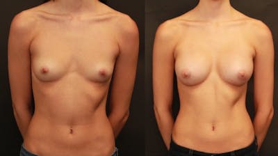 Breast Augmentation Before & After Gallery - Patient 11681777 - Image 1