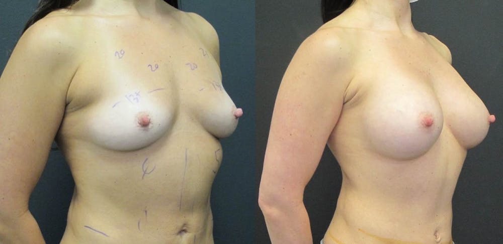 Breast Augmentation Before & After Gallery - Patient 11681778 - Image 4