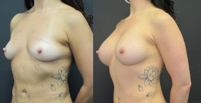 Breast Augmentation Before & After Gallery - Patient 11681778 - Image 2
