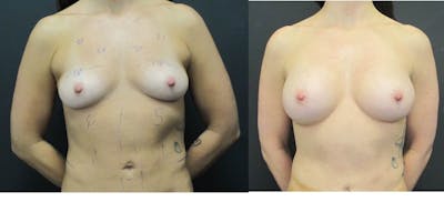 Breast Augmentation Before & After Gallery - Patient 11681778 - Image 1