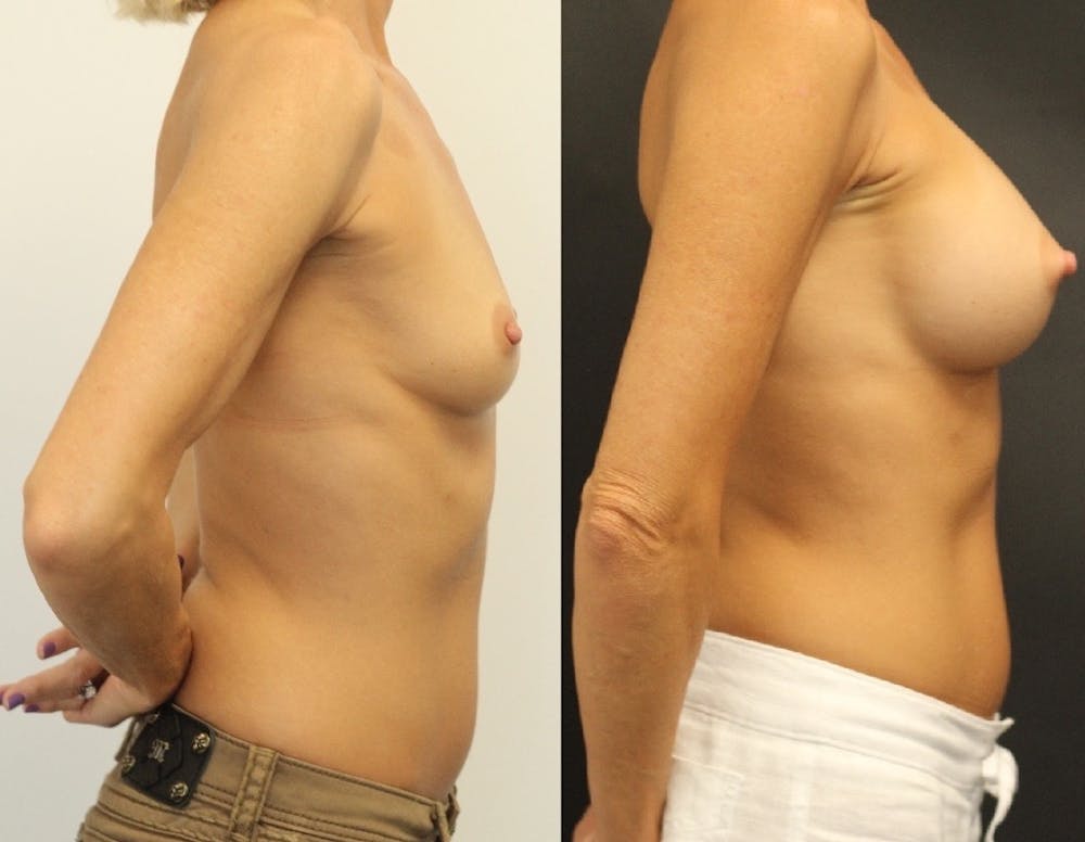 Breast Augmentation Before & After Gallery - Patient 11681779 - Image 3