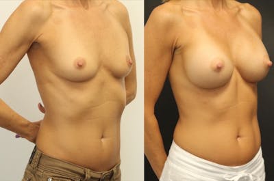 Breast Augmentation Before & After Gallery - Patient 11681779 - Image 2