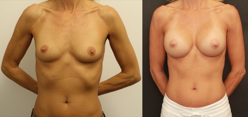 Breast Augmentation Gallery - Patient 11681779 - Image 1