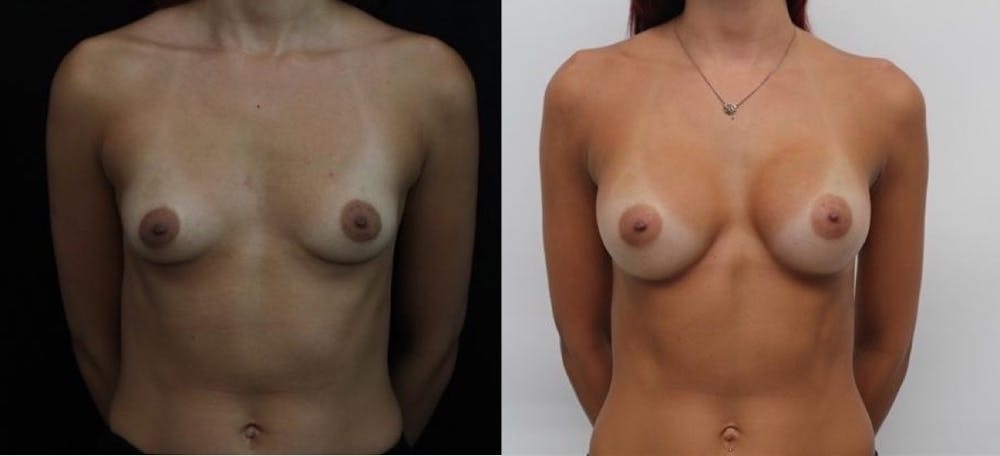 Breast Augmentation Before & After Gallery - Patient 11681780 - Image 1