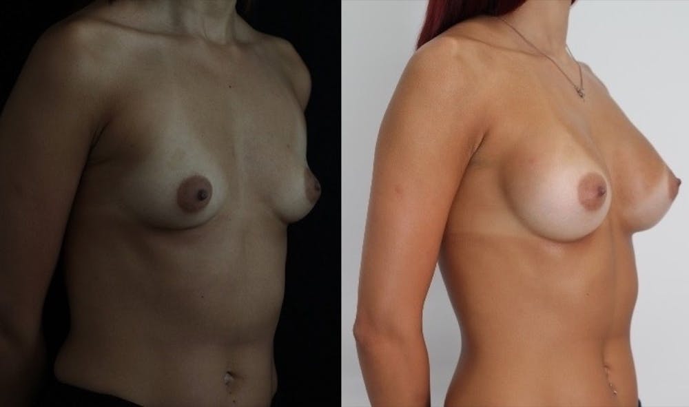 Breast Augmentation Gallery - Patient 11681780 - Image 4
