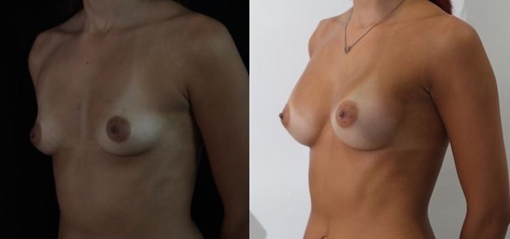 Breast Augmentation Gallery - Patient 11681780 - Image 2
