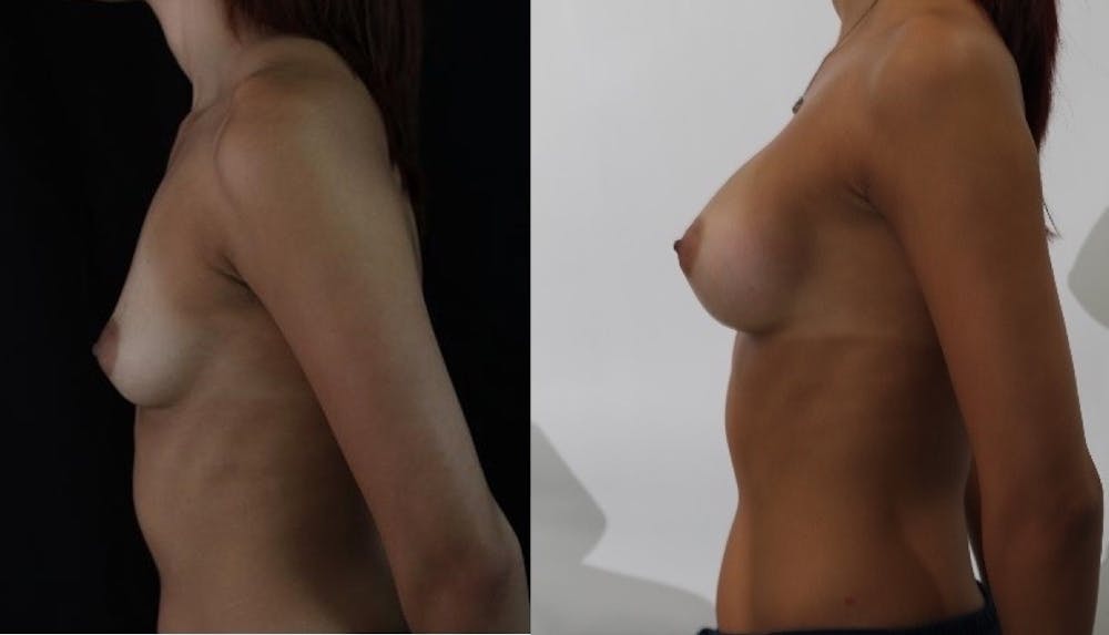 Breast Augmentation Before & After Gallery - Patient 11681780 - Image 3