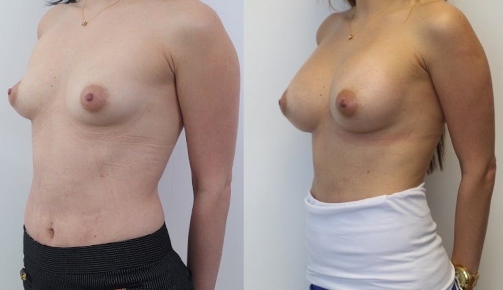 Breast Augmentation Before & After Gallery - Patient 11681781 - Image 2