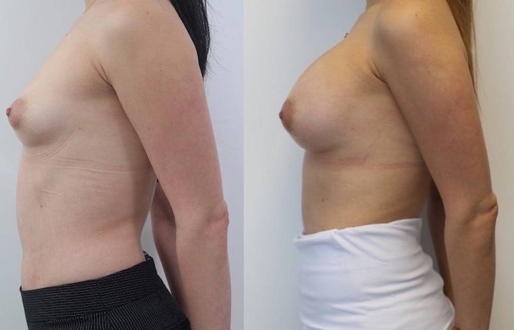 Breast Augmentation Before & After Gallery - Patient 11681781 - Image 3