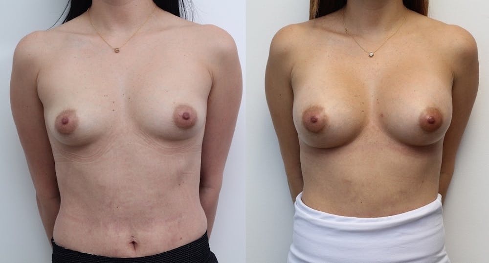Breast Augmentation Gallery - Patient 11681781 - Image 1