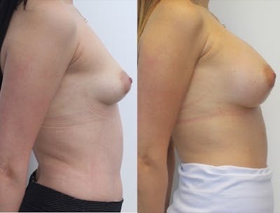 Breast Augmentation Before & After Gallery - Patient 11681781 - Image 4