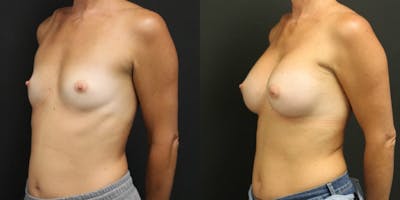 Breast Augmentation Before & After Gallery - Patient 11681782 - Image 2