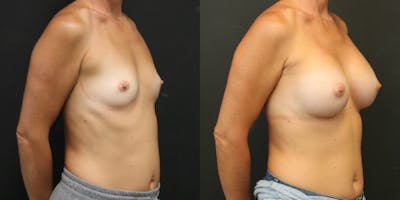 Breast Augmentation Before & After Gallery - Patient 11681782 - Image 4