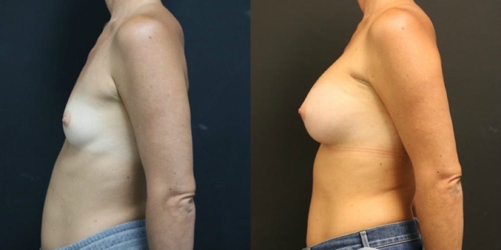 Breast Augmentation Before & After Gallery - Patient 11681782 - Image 3