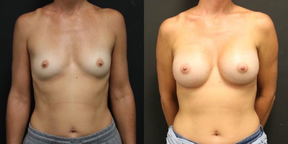 Breast Augmentation Before & After Gallery - Patient 11681782 - Image 1
