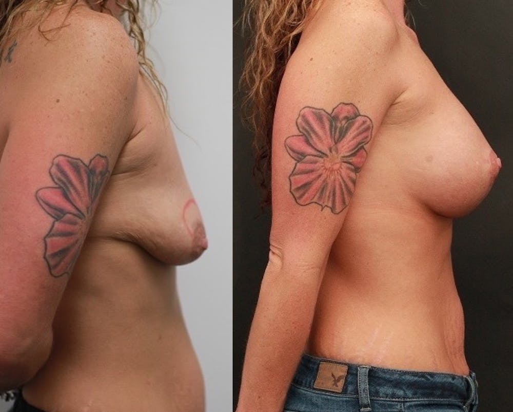 Breast Lift Before & After Gallery - Patient 11681795 - Image 5