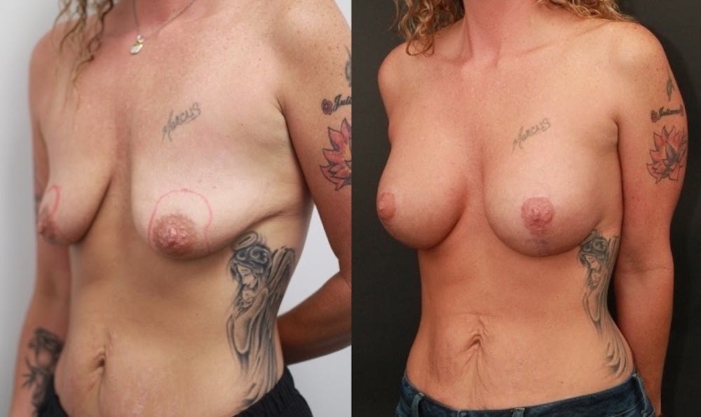 Breast Lift Before & After Gallery - Patient 11681795 - Image 3