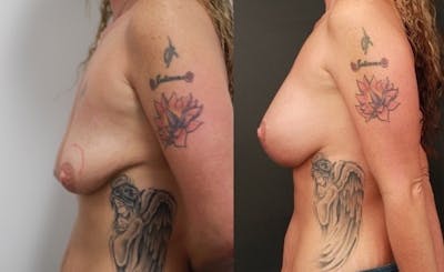 Breast Lift Before & After Gallery - Patient 11681795 - Image 4