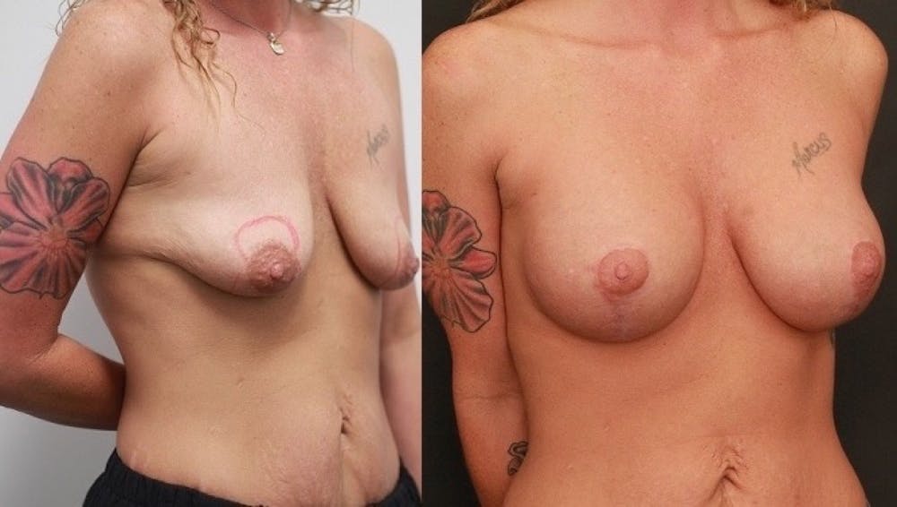 Breast Lift Before & After Gallery - Patient 11681795 - Image 2