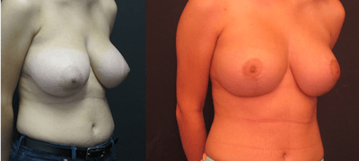 Breast Lift Before & After Gallery - Patient 11681804 - Image 2