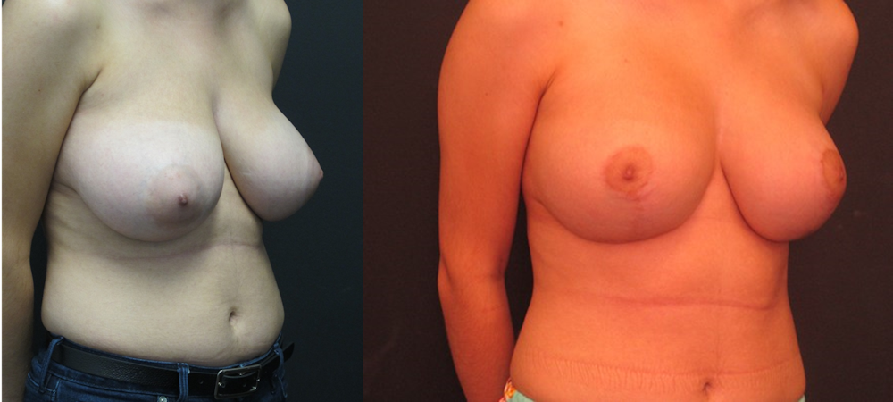 Breast Lift