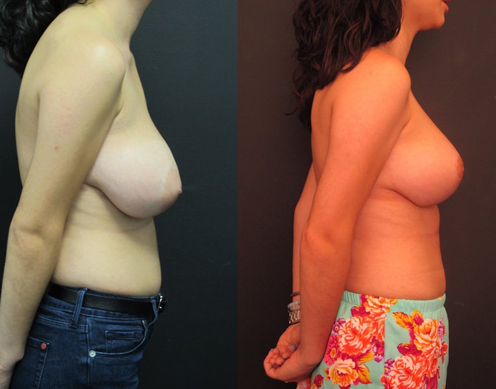 Breast Lift Before & After Gallery - Patient 11681804 - Image 3