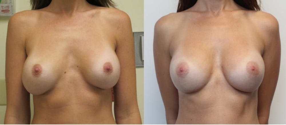 Breast Revision Before & After Gallery - Patient 11681812 - Image 1