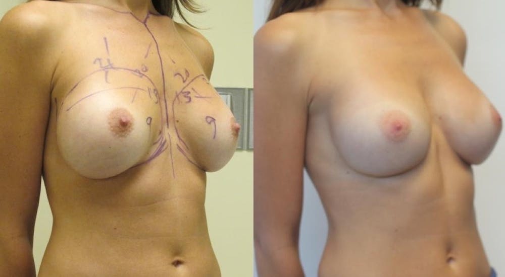 Breast Revision Before & After Gallery - Patient 11681812 - Image 2