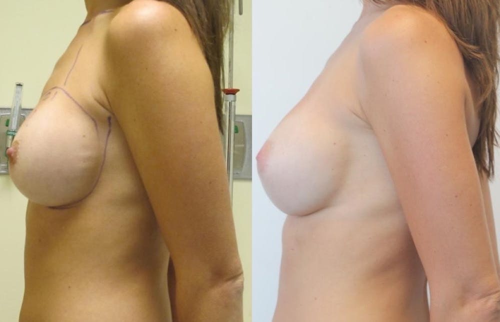 Breast Revision Before & After Gallery - Patient 11681812 - Image 4