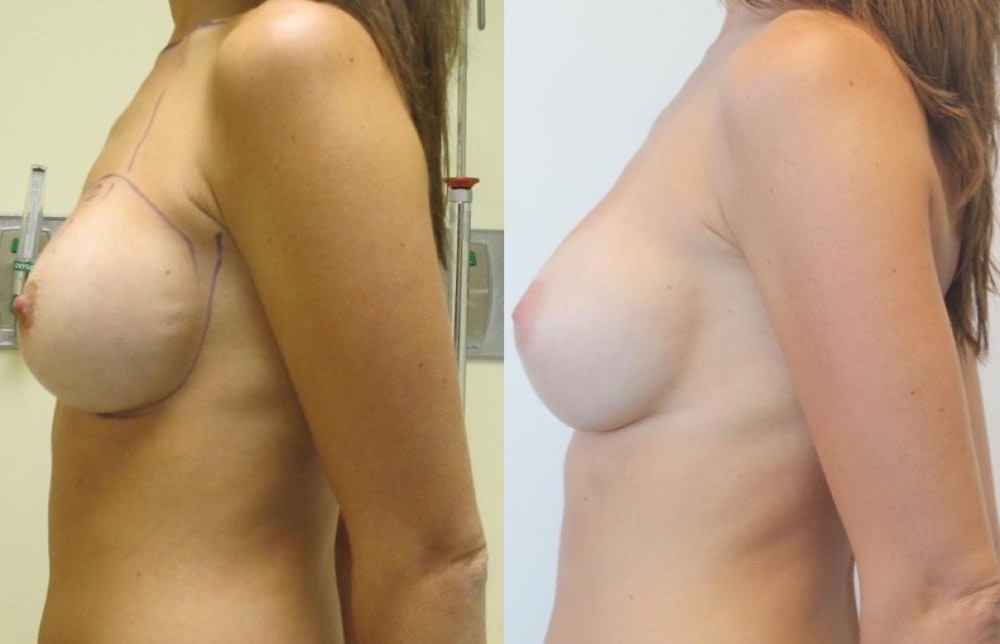 Breast Revision