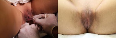 Labiaplasty Before & After Gallery - Patient 11681830 - Image 1
