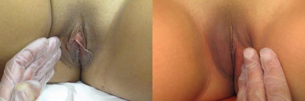 Labiaplasty Before & After Gallery - Patient 11681831 - Image 1