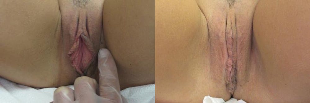 Labiaplasty Before & After Gallery - Patient 11681832 - Image 1