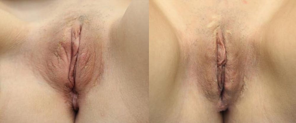 Labiaplasty Before & After Gallery - Patient 11681833 - Image 1