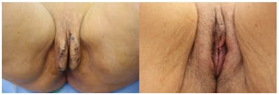 Labiaplasty Before & After Gallery - Patient 11681834 - Image 1